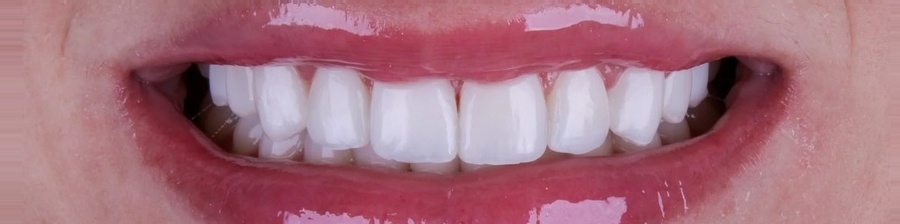 Sorriso depois das lentes de contato dental em porcelana