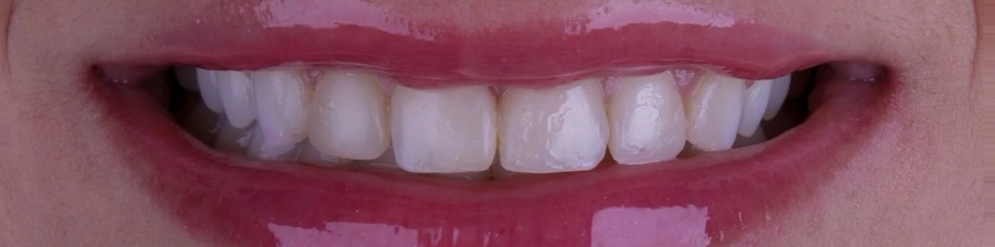 Sorriso antes das lentes de contato dental em porcelana