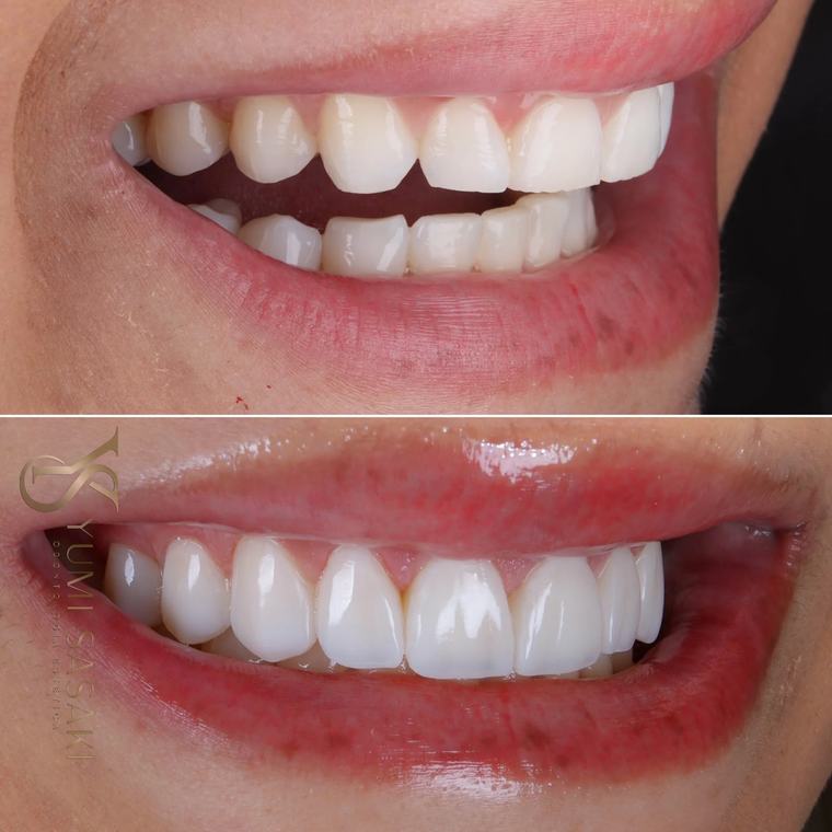 Sorriso antes e depois do fechamento do espaço entre os dentes frontais com lentes de contato dental
