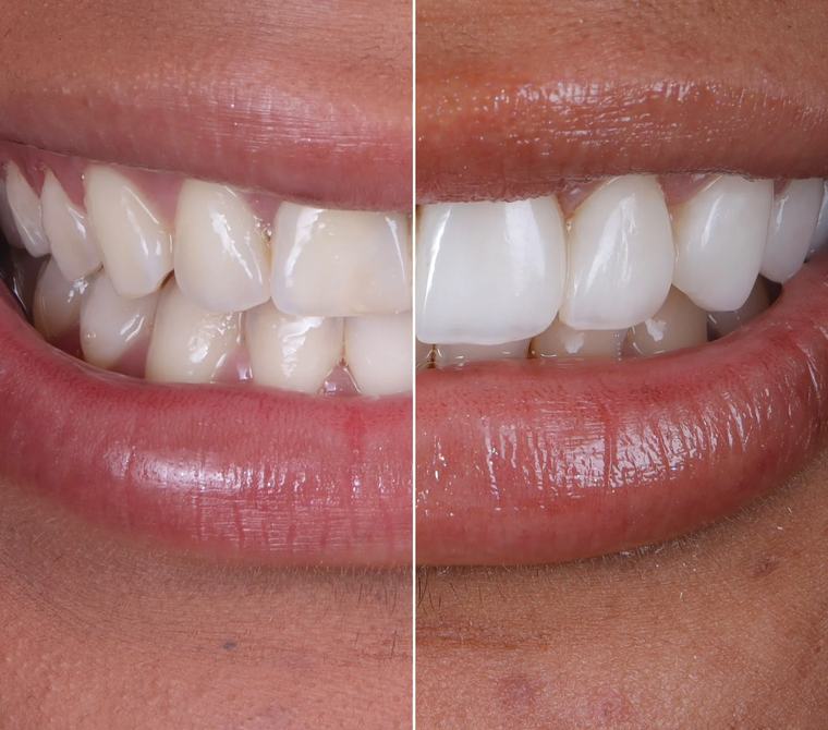 Sorriso antes e depois de clareamento e lentes de contato dental, com dentes mais brancos e uniformes