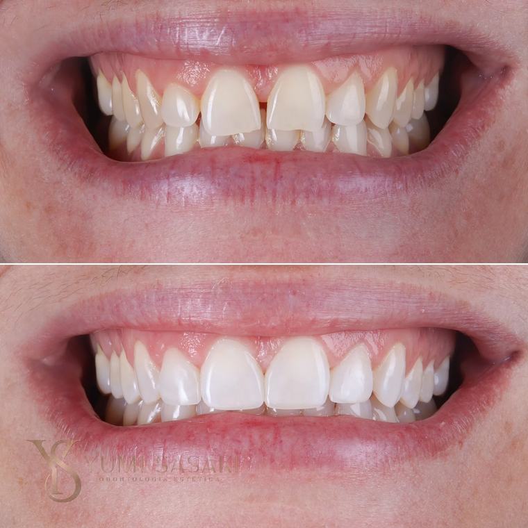 Sorriso antes e depois da correção de dentes frontais irregulares com facetas de porcelana