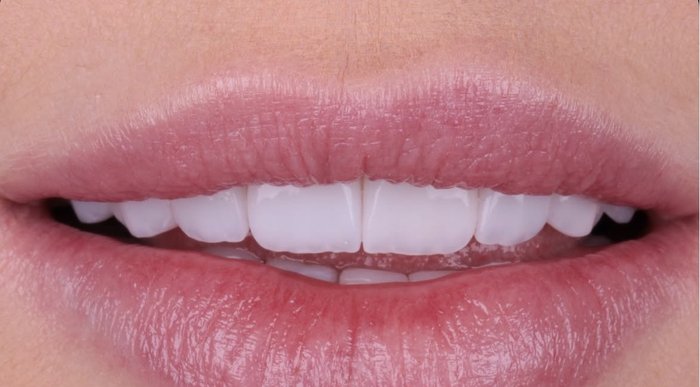 Detalhe de sorriso com lentes de contato dental, vista frontal