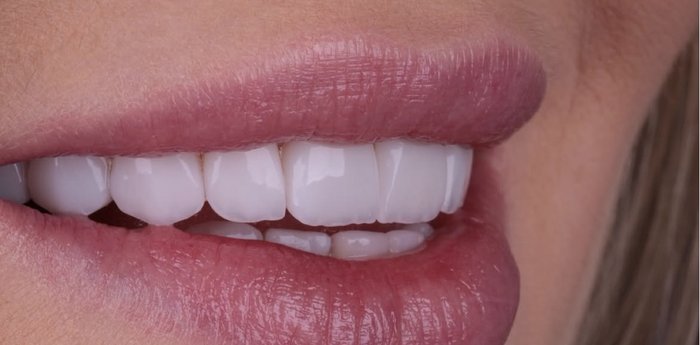 Detalhe de sorriso com lentes de contato dental, vista lateral