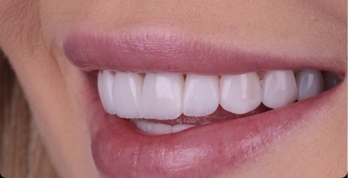 Detalhe de sorriso com lentes de contato dental, outro ângulo